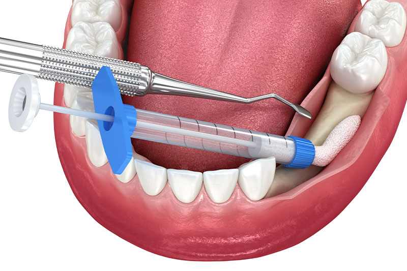 Bone Grafting in Houston