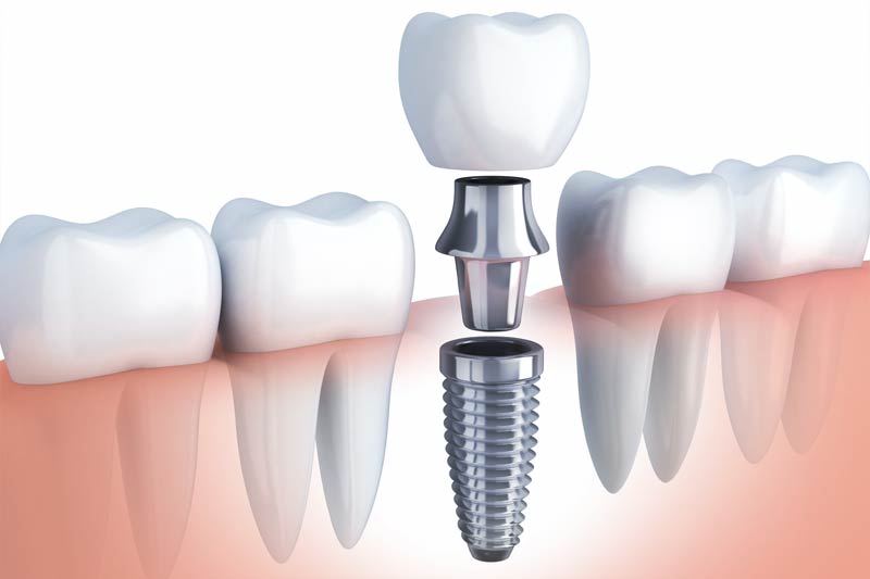 Dental Implants in Houston