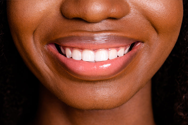 Gummy Smile in Houston