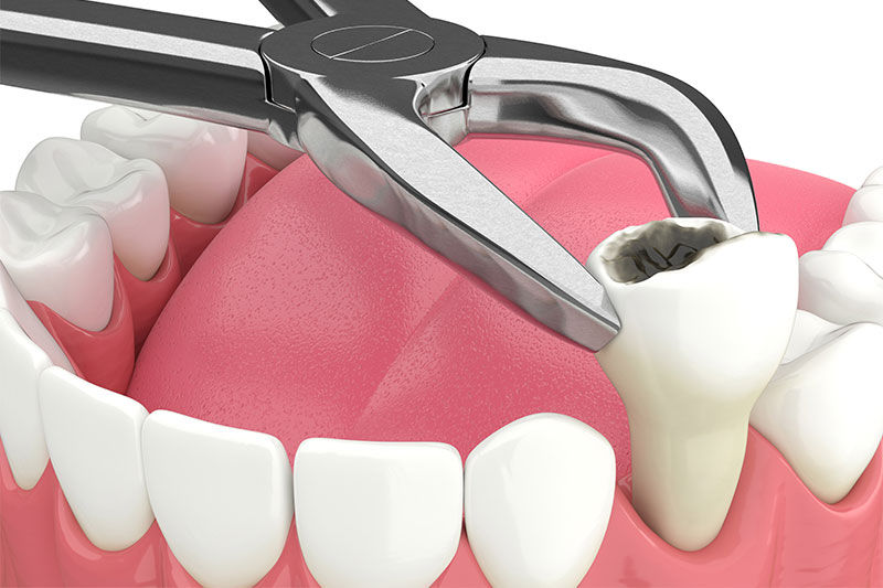 Tooth Extractions in Houston